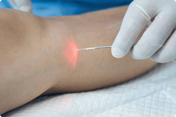 Close up photo of a laser fiber in hand of a doctor in latex glove