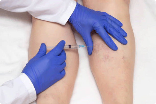 Doctor in medical gloves injects sclerotherapy procedure on the legs of a woman against varicose veins, close-up, ozone therapy