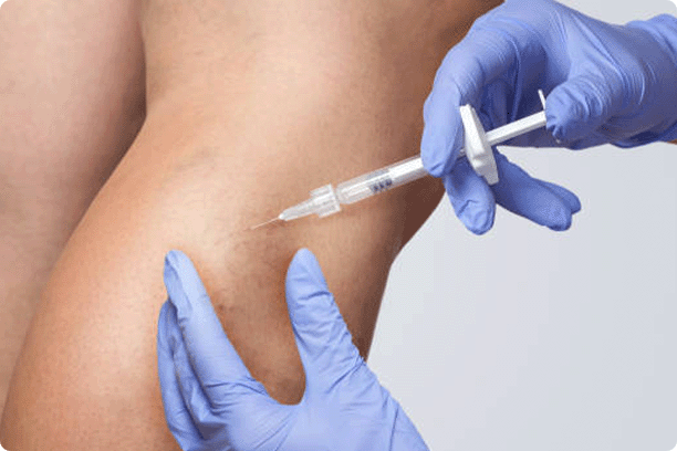 A doctor does medical procedure Sclerotherapy used to eliminate varicose veins and spider veins. An injection of a solution directly into the vein.