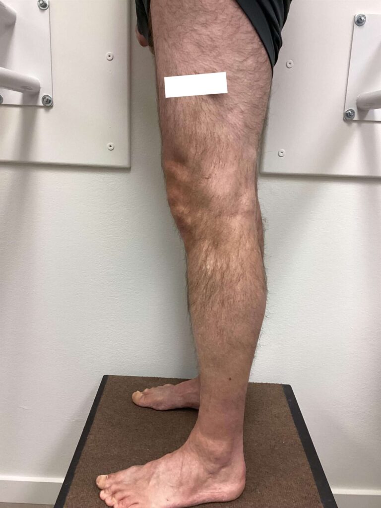 After Image: Varicose Veins - left-side