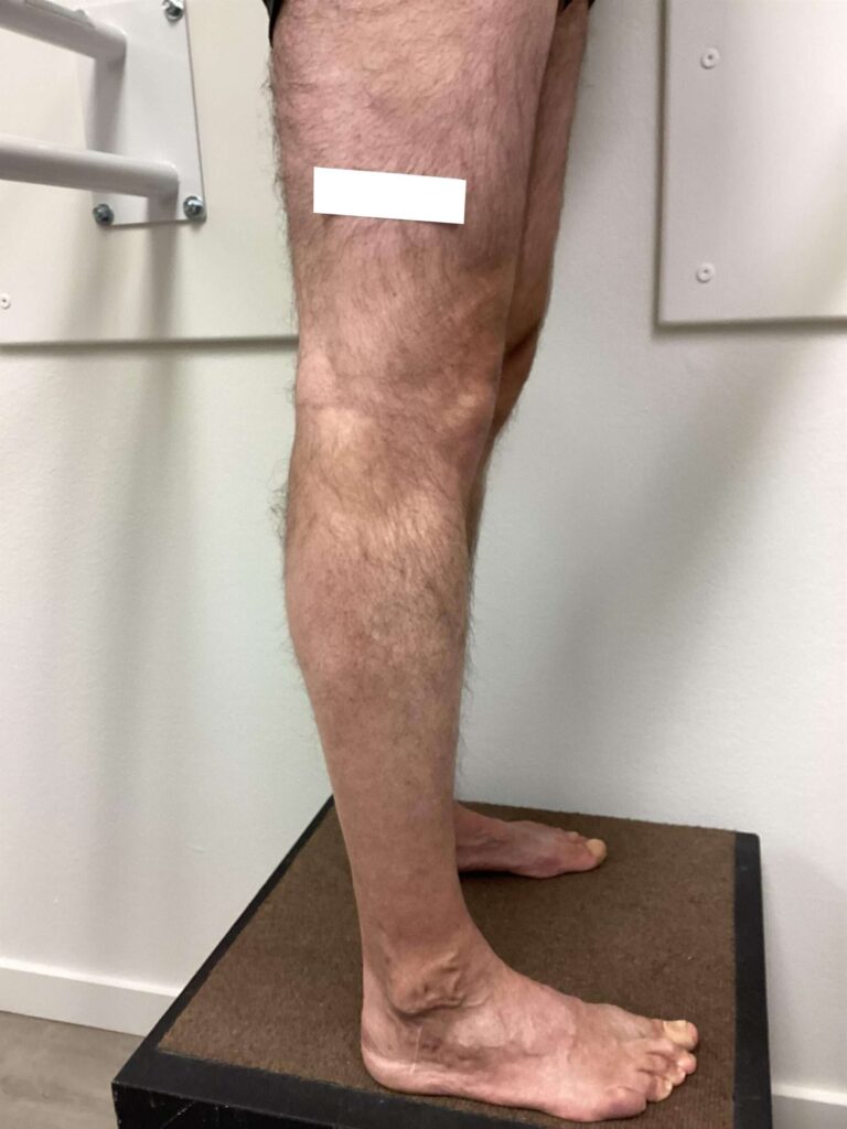 After Image: Varicose Veins - right-side