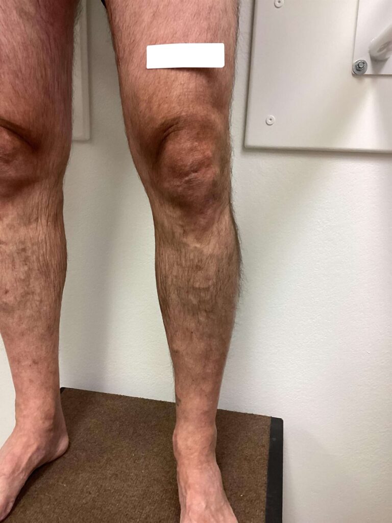 After Image: Varicose Veins - front
