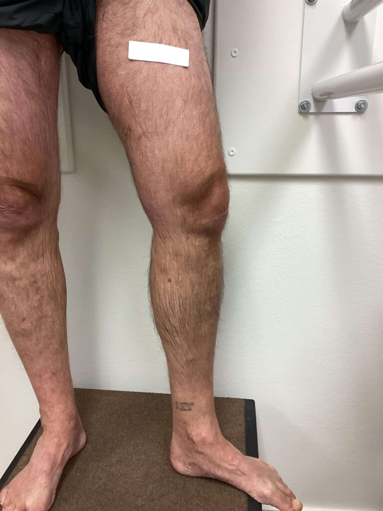 After Image: Varicose Veins - front