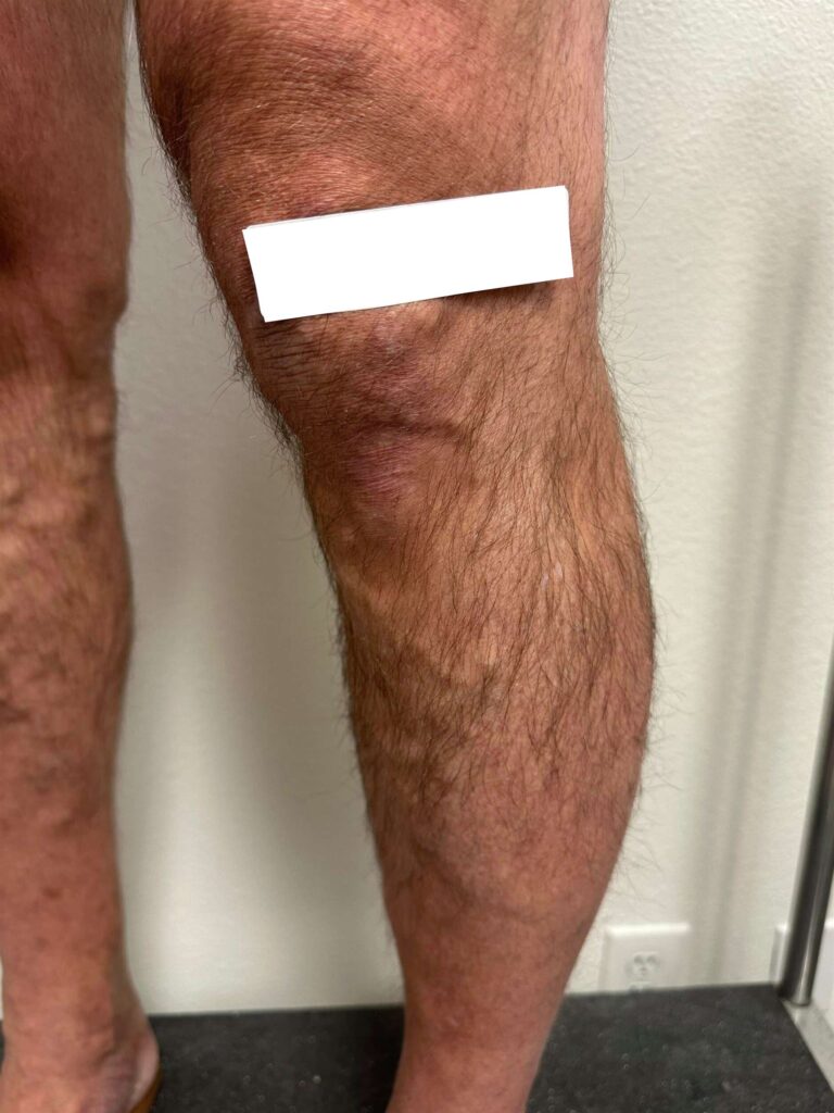 Before Image: Varicose Veins - left-side