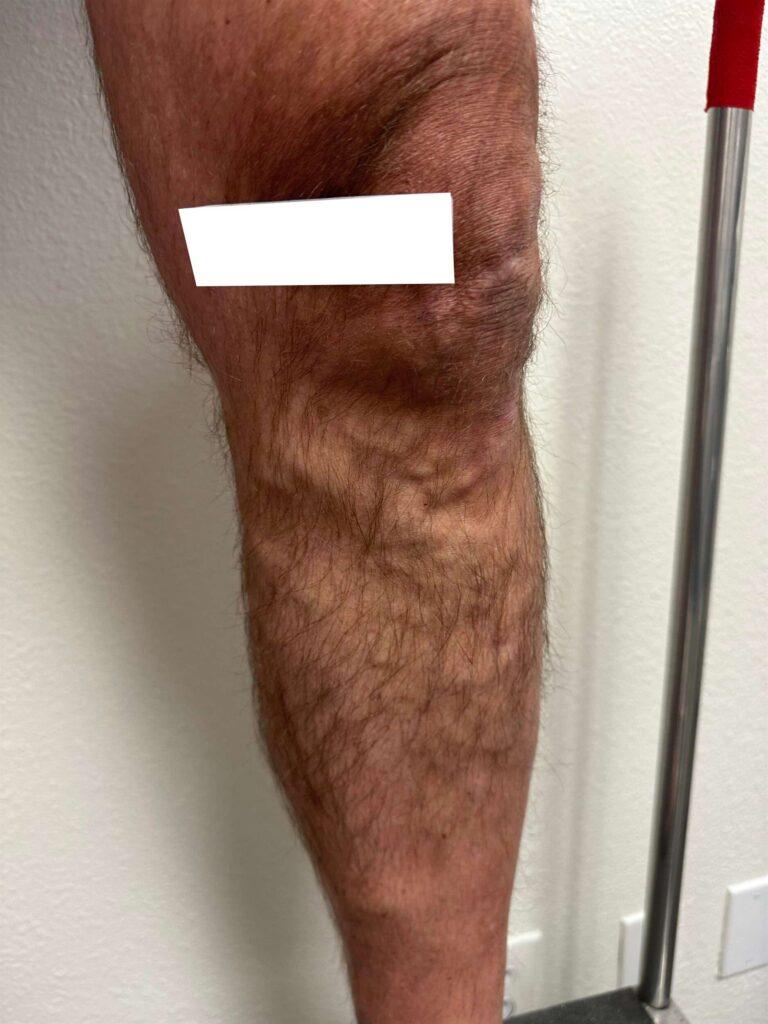 Before Image: Varicose Veins - right-side