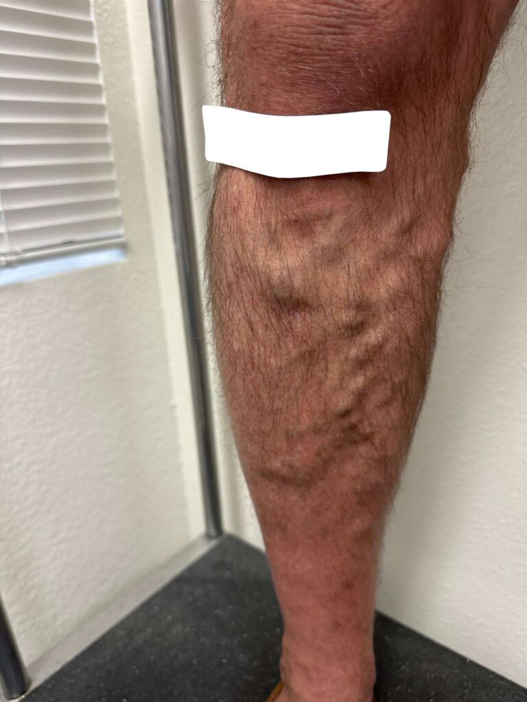 Before Image: Varicose Veins - front