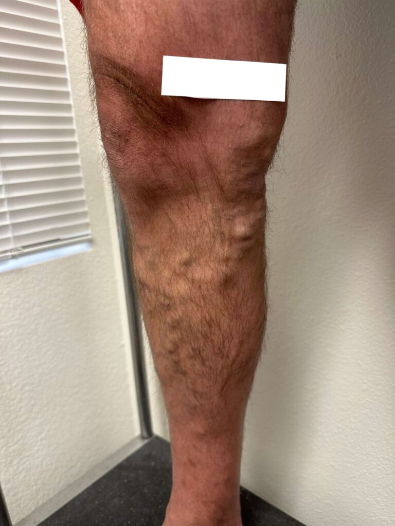 Before Image: Varicose Veins - front