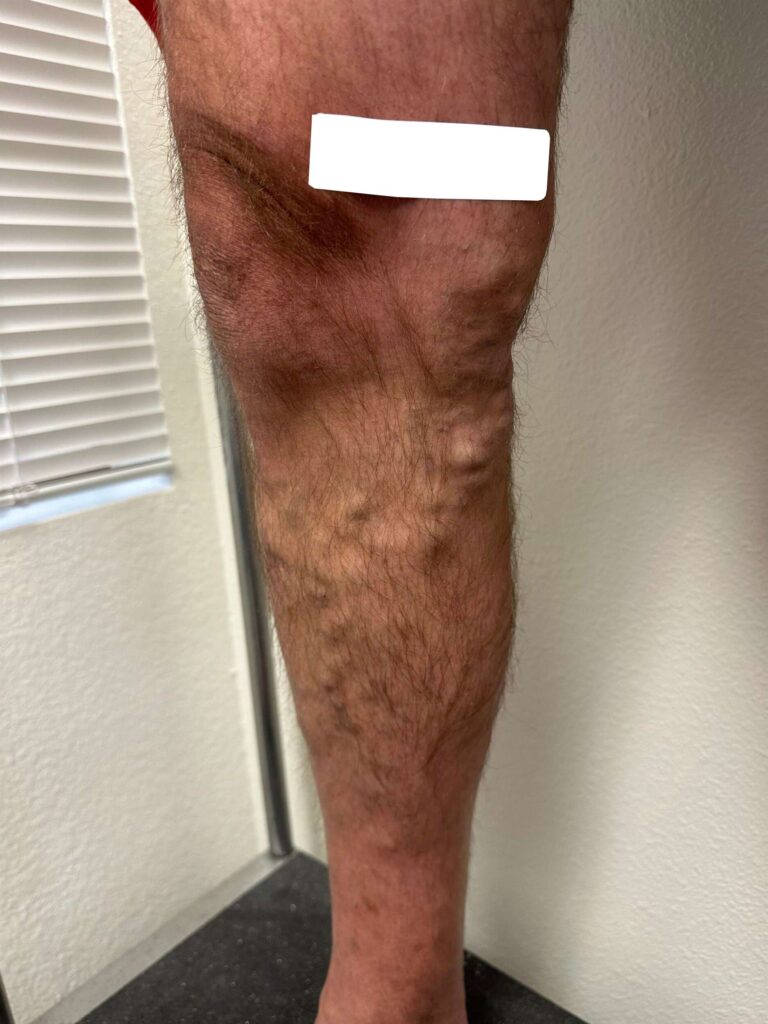 Before Image: Varicose Veins - front