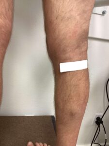 After Image: Varicose Veins