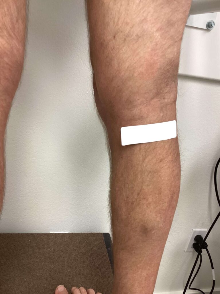 After Image: Varicose Veins - back