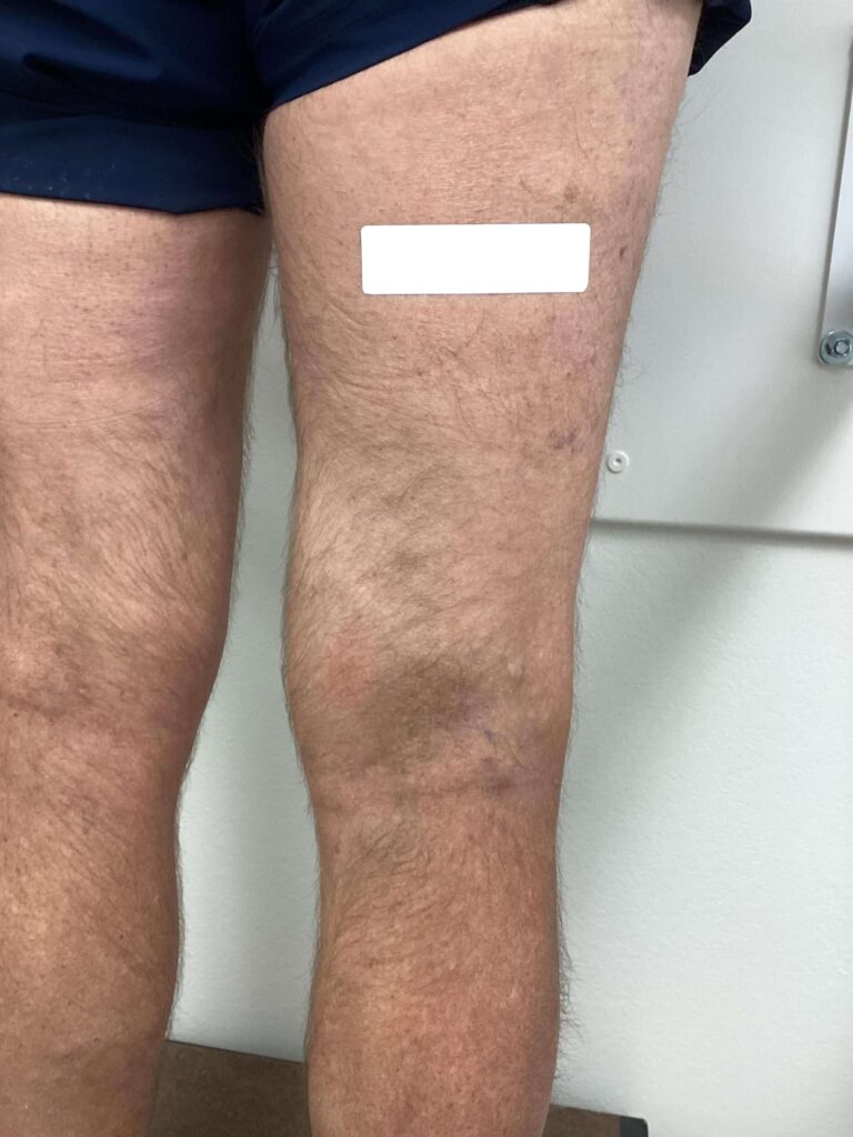 After Image: Varicose Veins - back