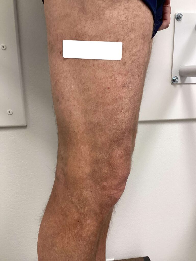 After Image: Varicose Veins - right-side
