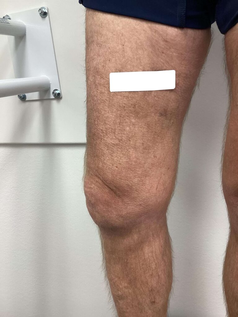 After Image: Varicose Veins - left-side