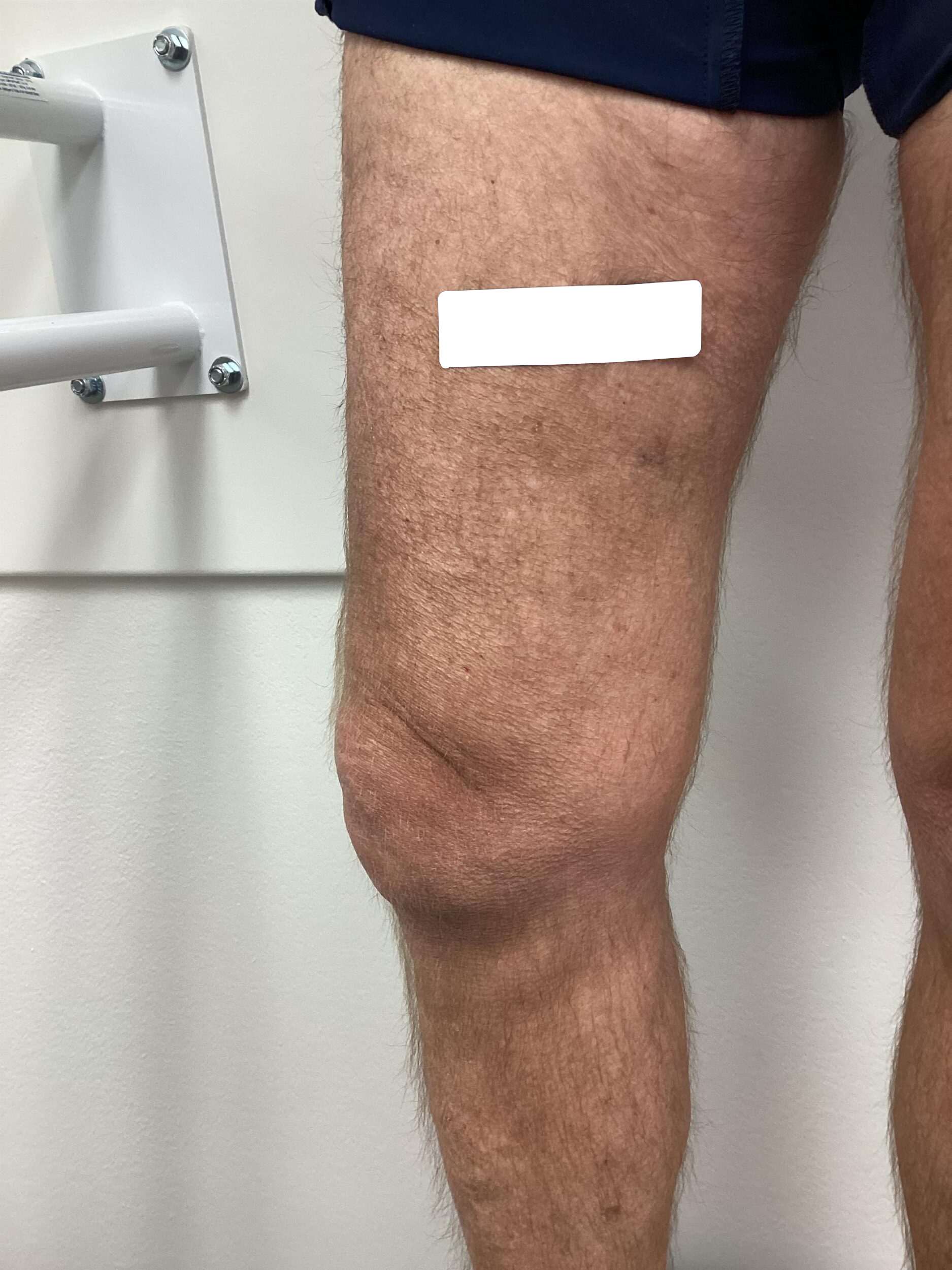 After Image: Varicose Veins - left-side