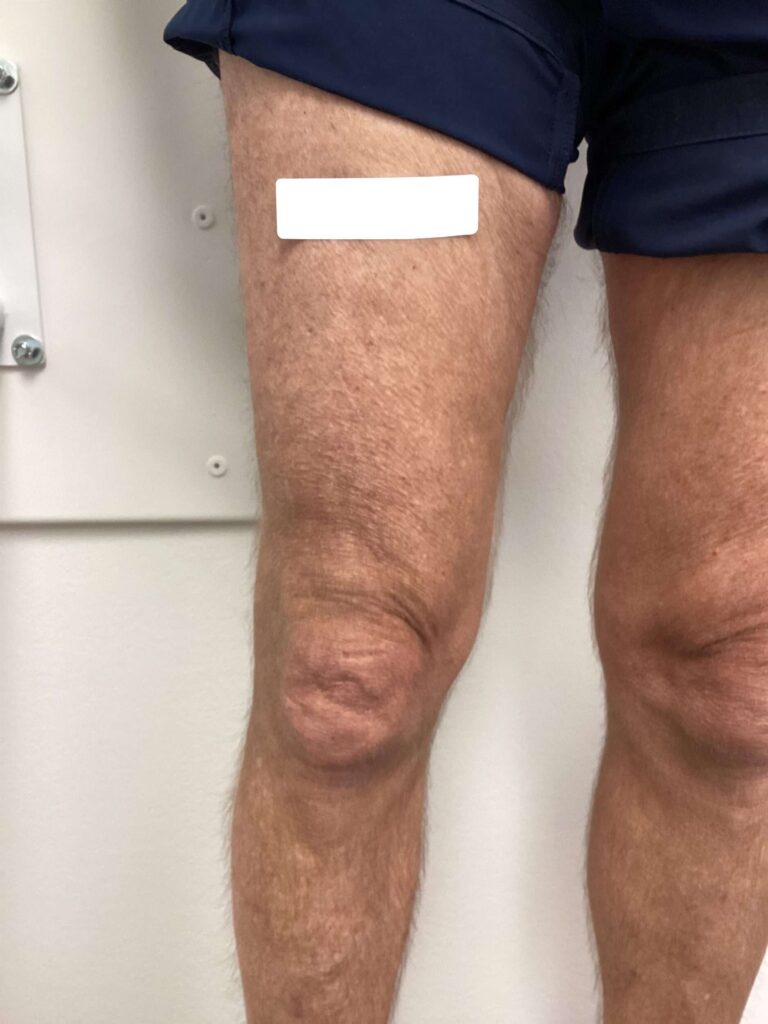 After Image: Varicose Veins - front