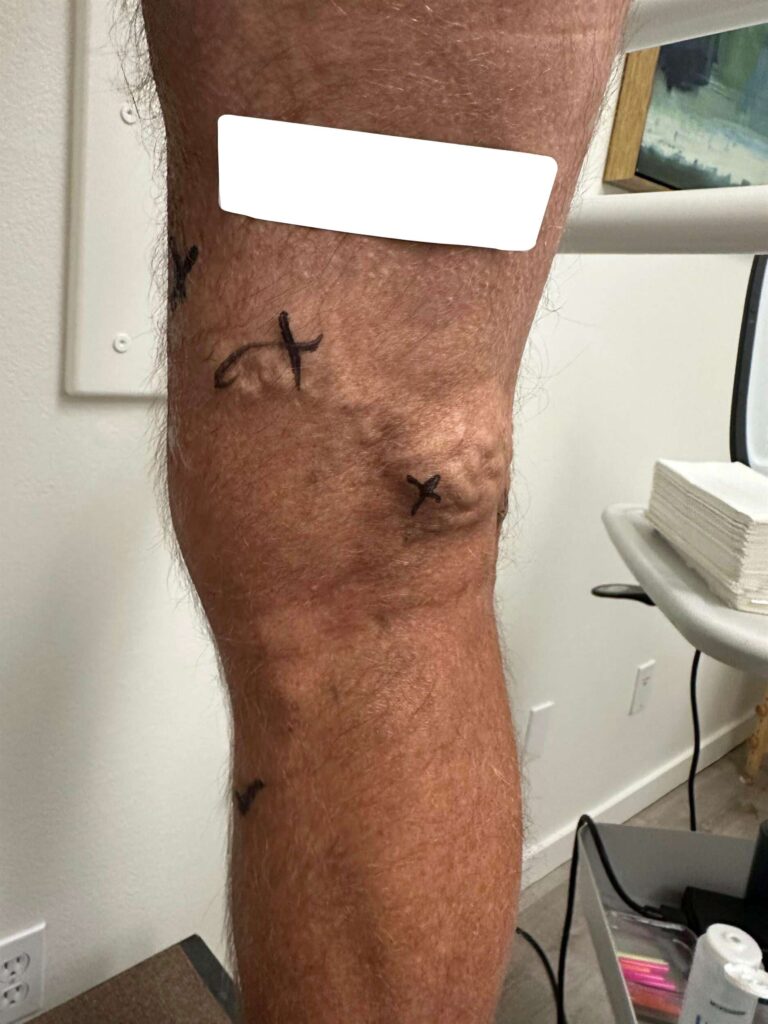 Before Image: Varicose Veins - back