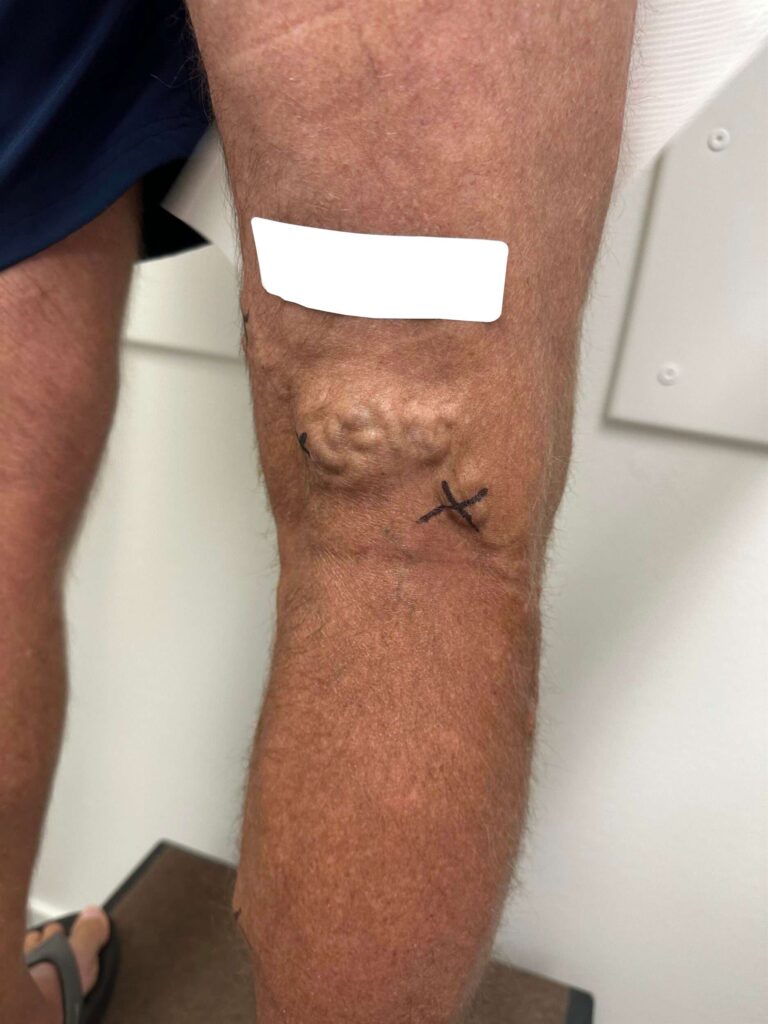 Before Image: Varicose Veins - back
