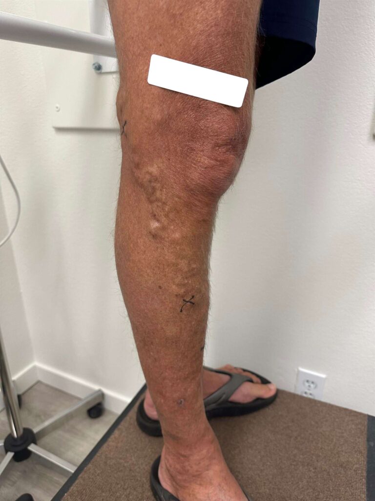 Before Image: Varicose Veins - right-side