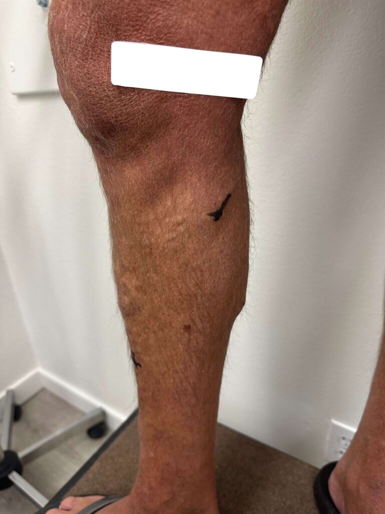 Before Image: Varicose Veins - left-side