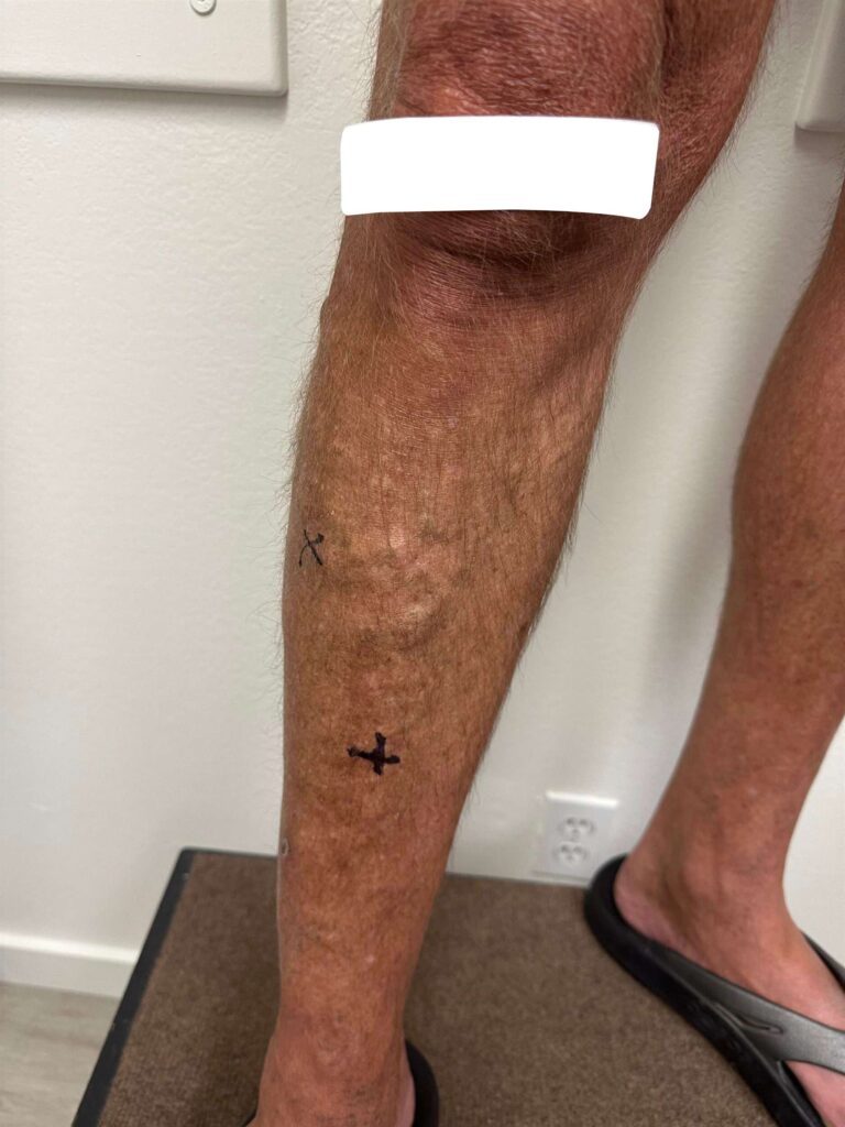 Before Image: Varicose Veins - front