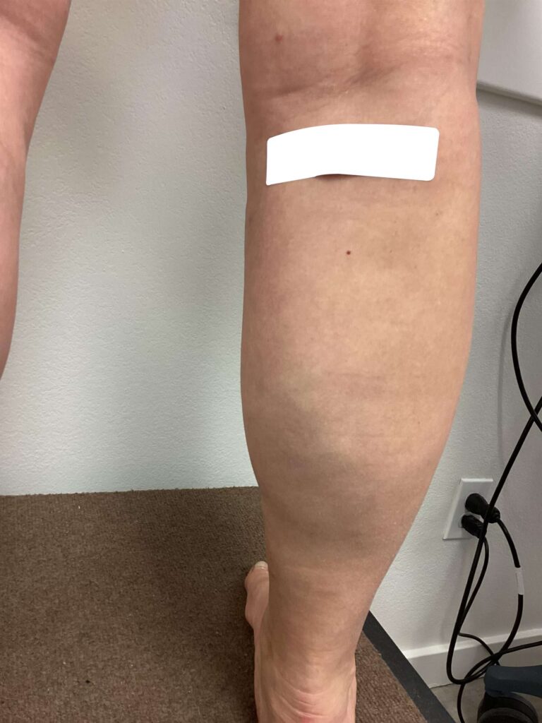 After Image: Varicose Veins - back