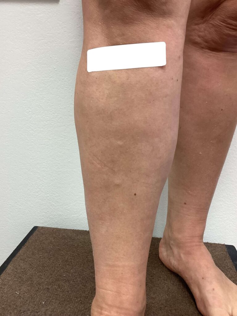 After Image: Varicose Veins - front