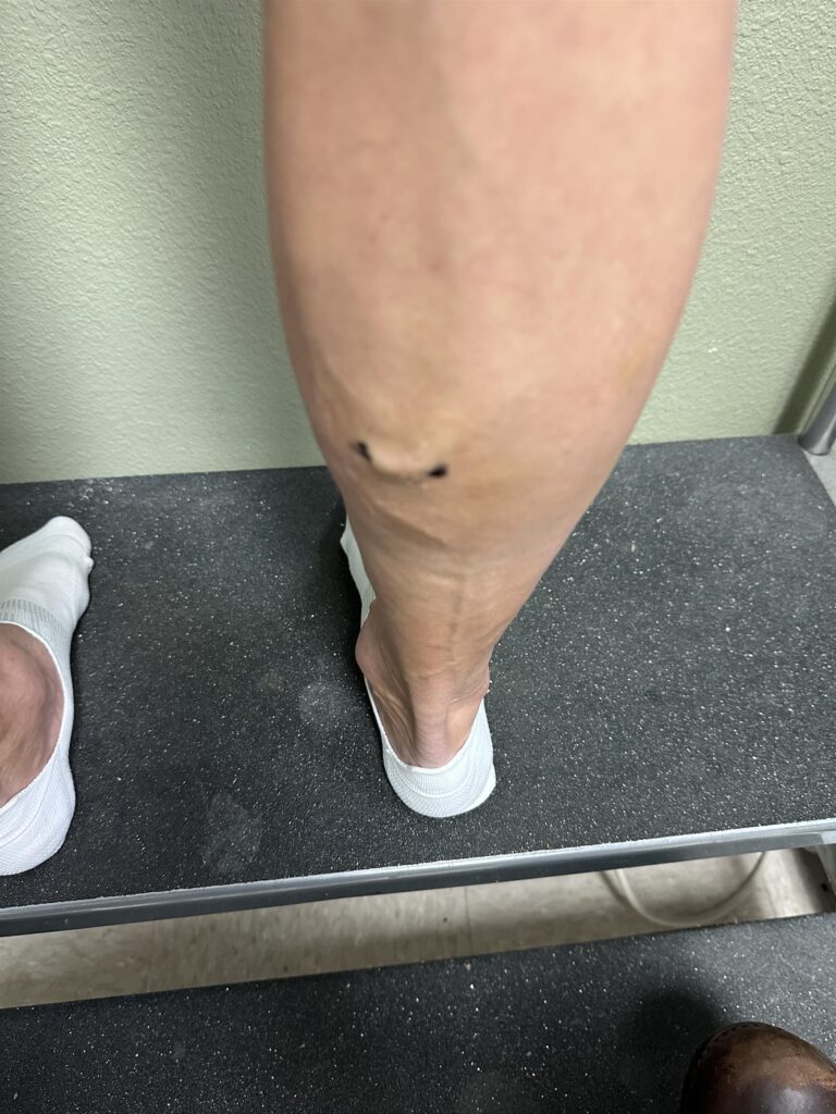 Before Image: Varicose Veins - back