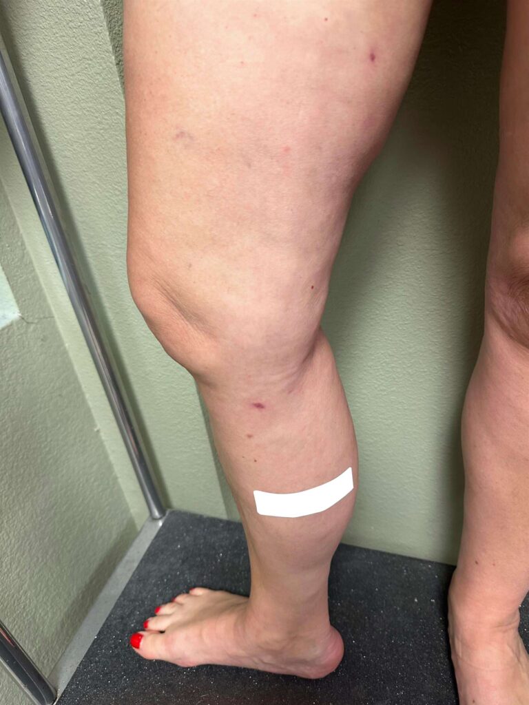 Before Image: Varicose Veins - front