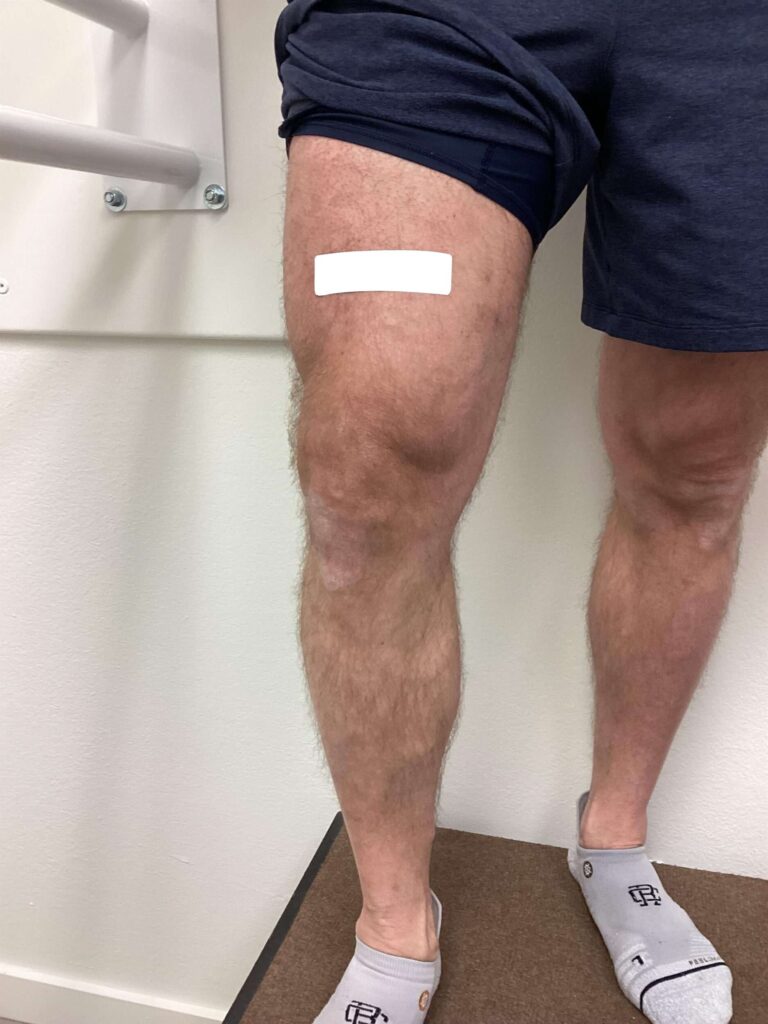 After Image: Varicose Veins - front
