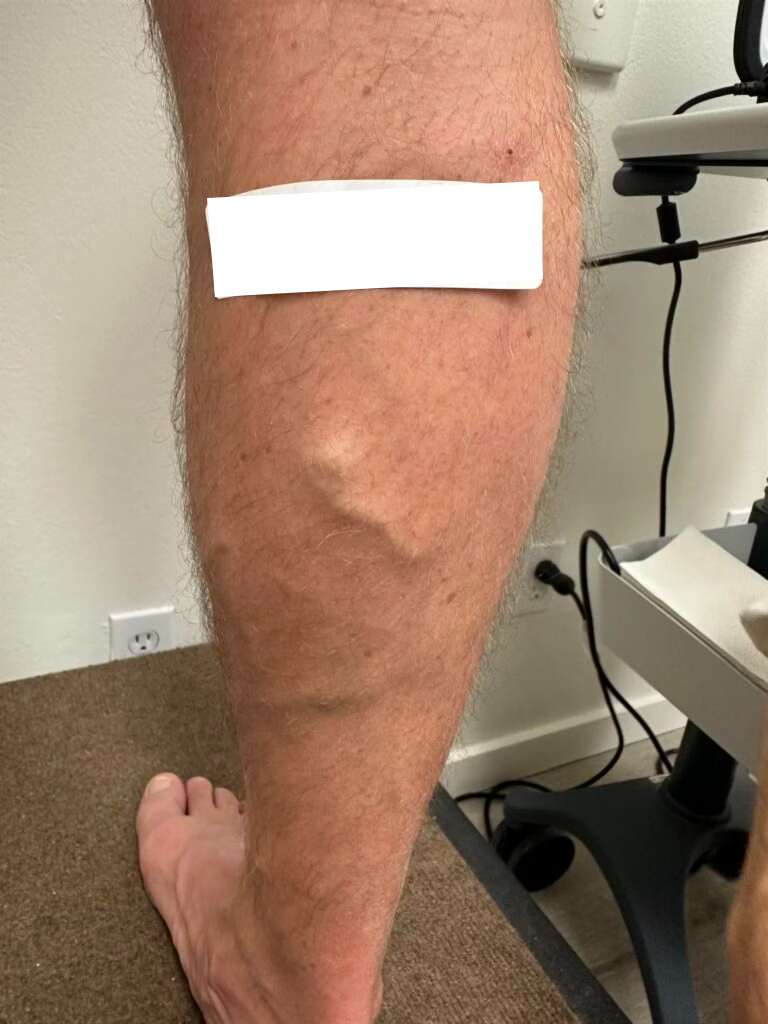 Before Image: Varicose Veins - back