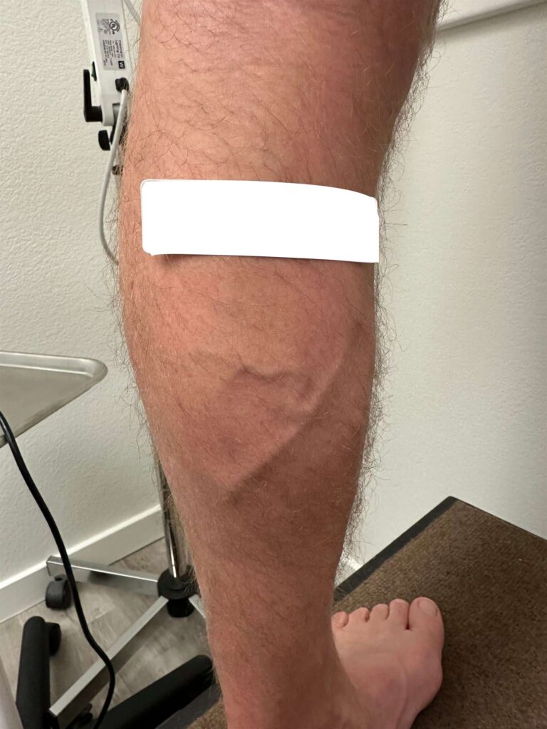 Before Image: Varicose Veins - back