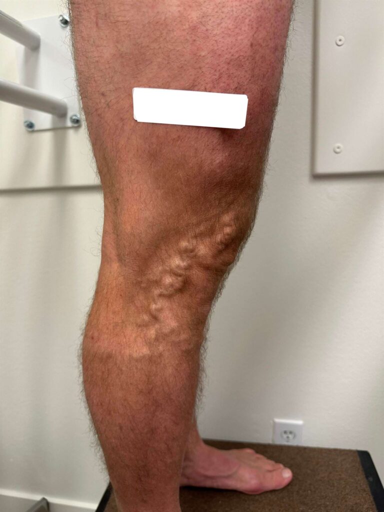Before Image: Varicose Veins - right-side