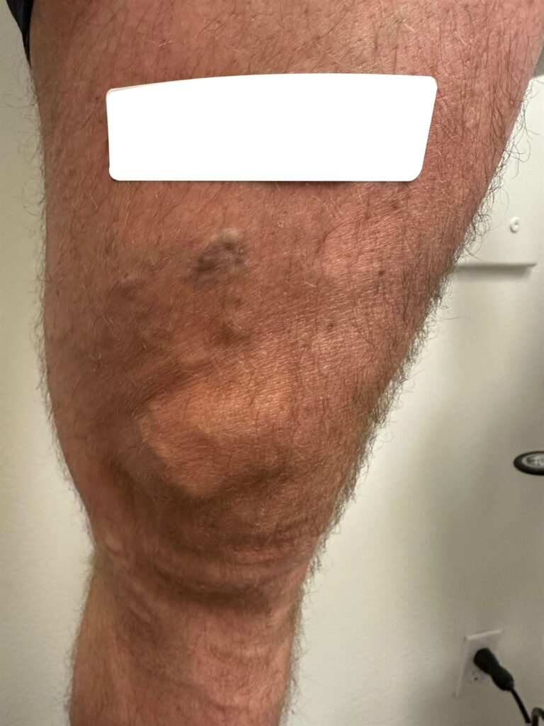 Before Image: Varicose Veins - front