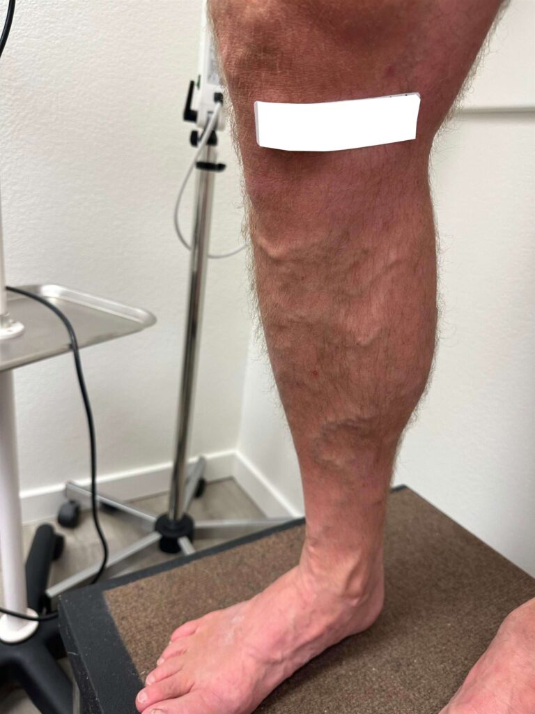 Before Image: Varicose Veins - left-side