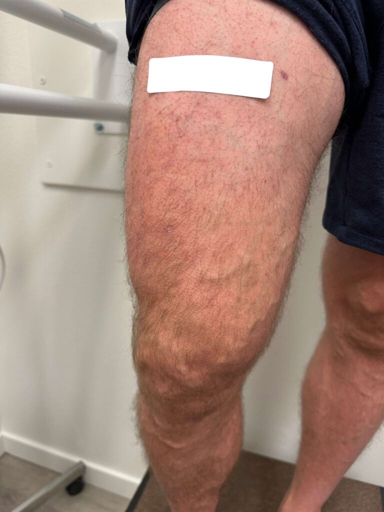 Before Image: Varicose Veins - front