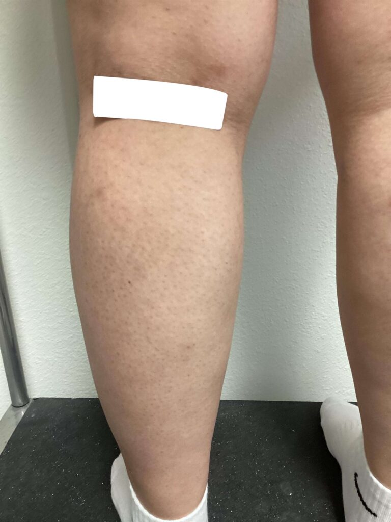 After Image: Spider Veins - left-back-oblique