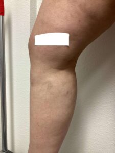 After Image: Spider Veins