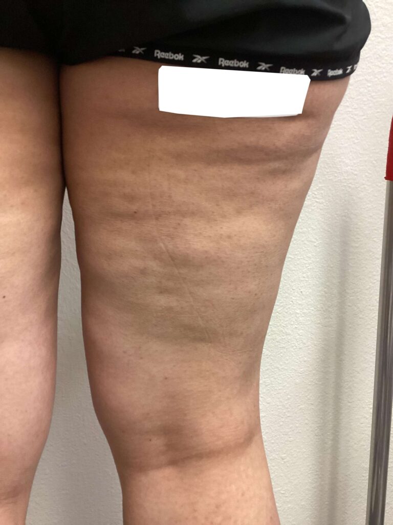 After Image: Spider Veins - back