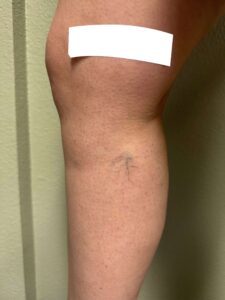 Before Image: Spider Veins