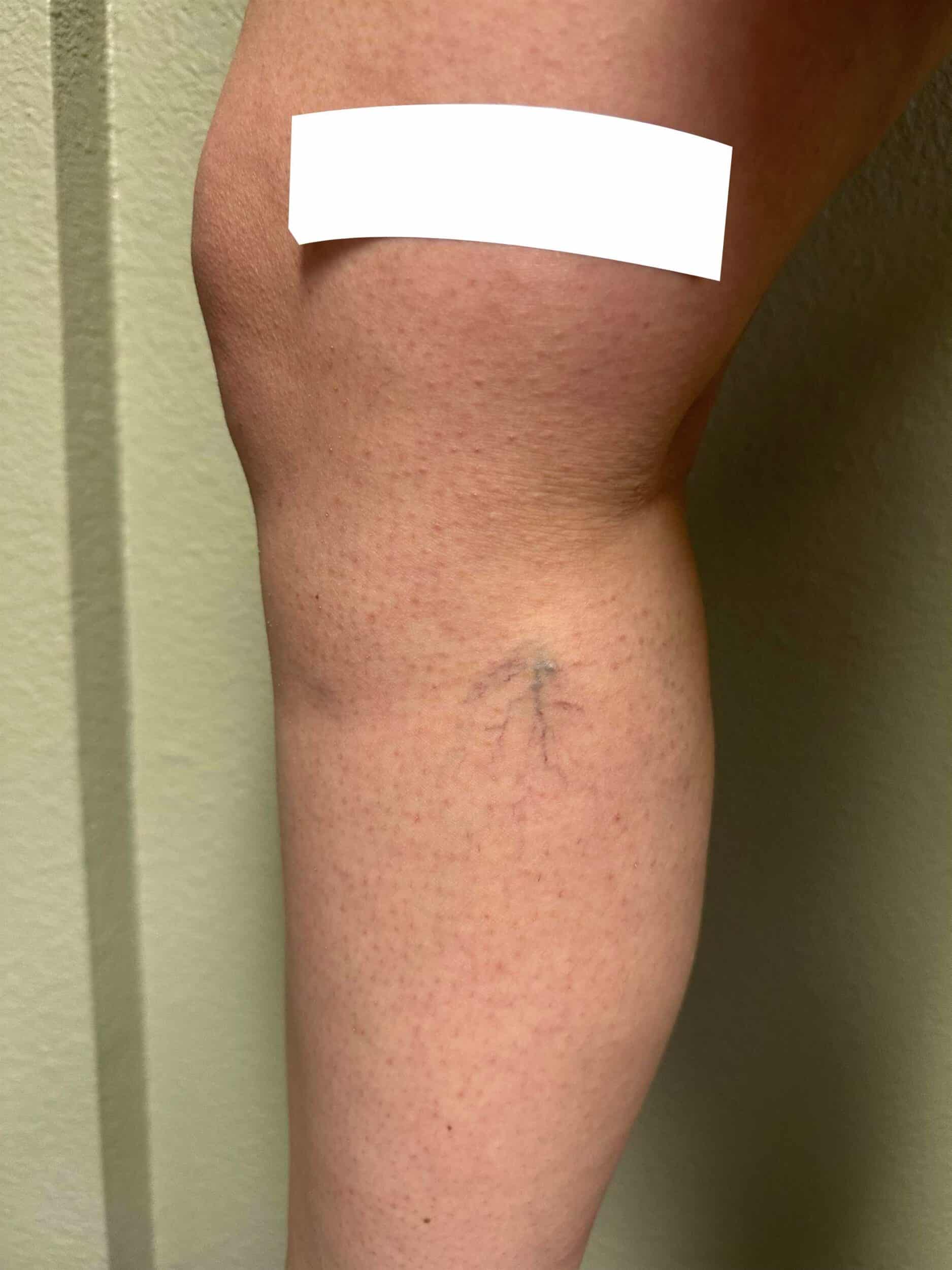 Before Image: Spider Veins - front