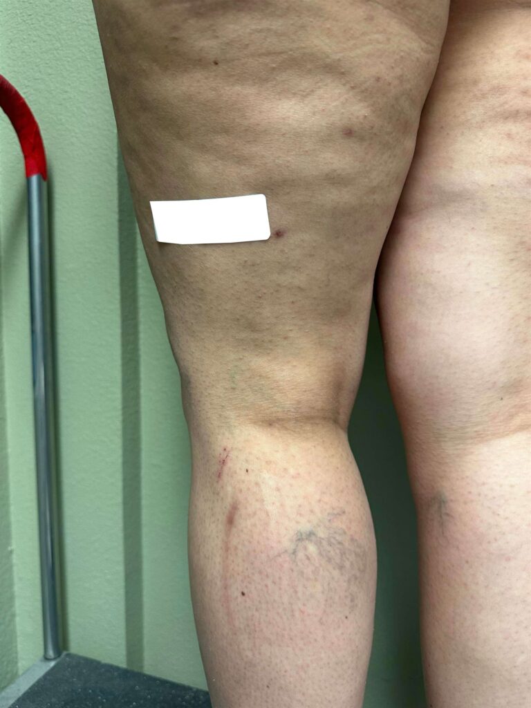 Before Image: Spider Veins - left-back-oblique