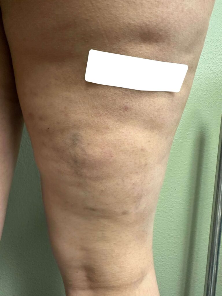Before Image: Spider Veins - back