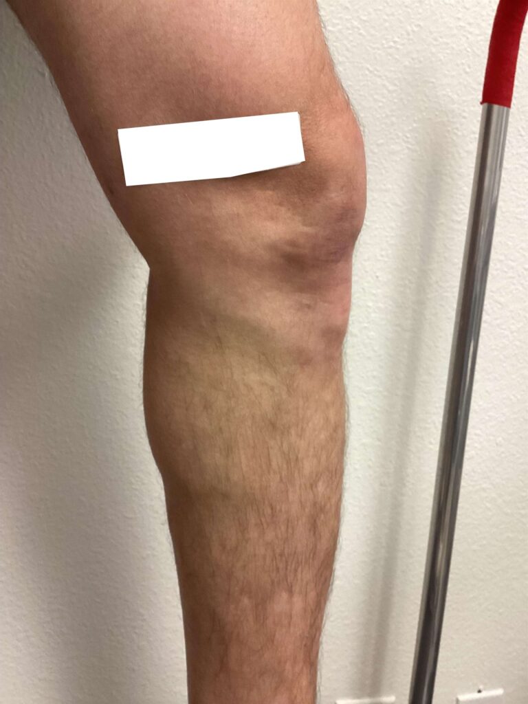 After Image: Varicose Veins - left-side
