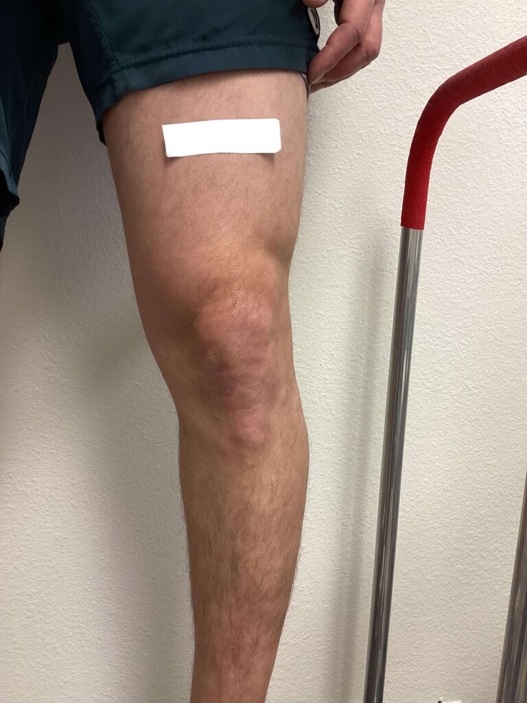 After Image: Varicose Veins - front