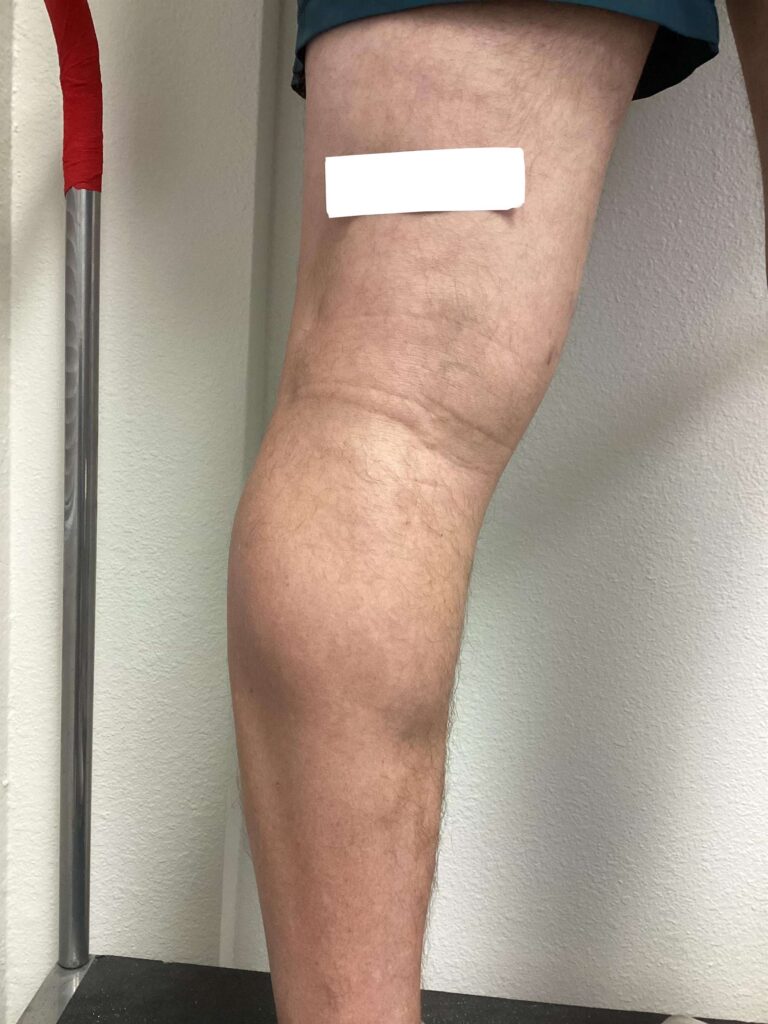 After Image: Varicose Veins - back