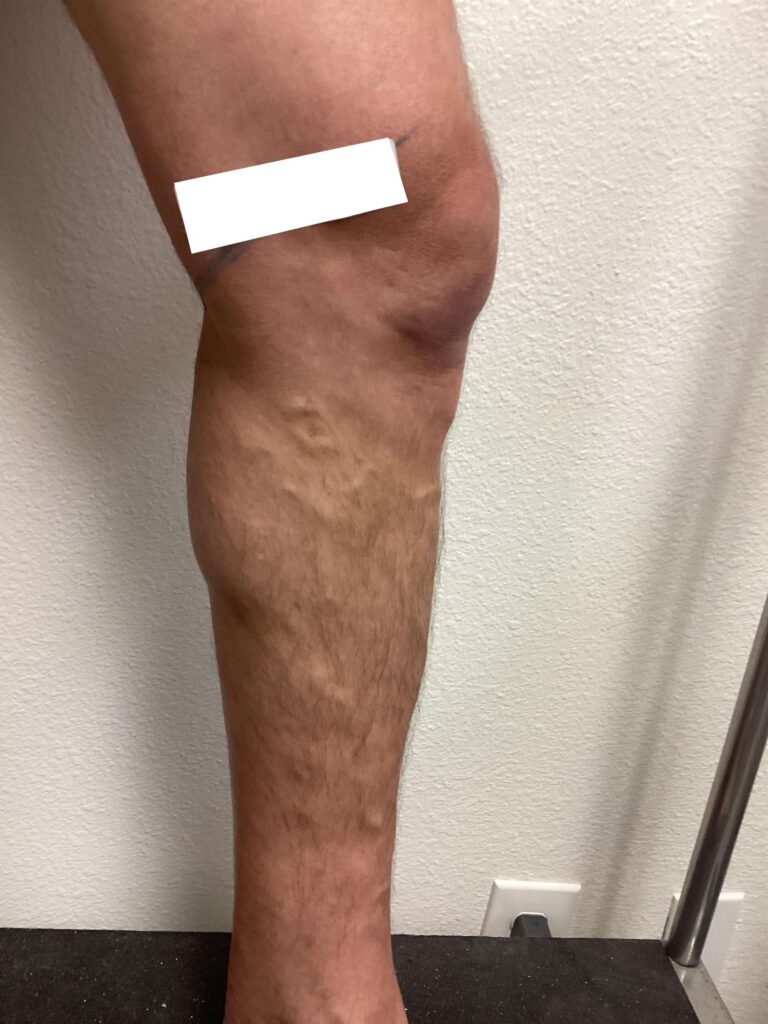 Before Image: Varicose Veins - left-side
