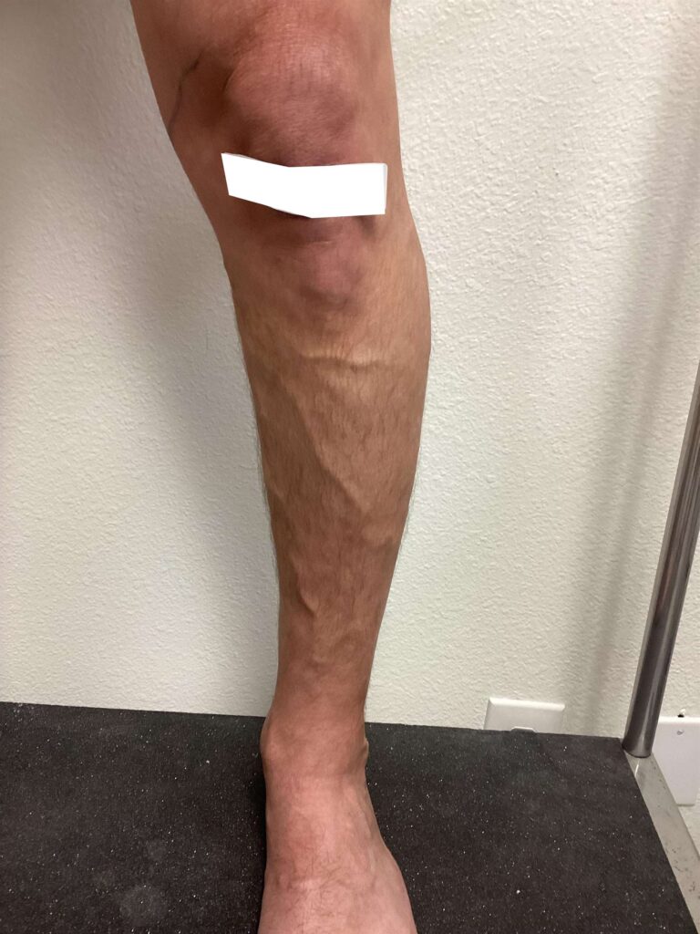 Before Image: Varicose Veins - front