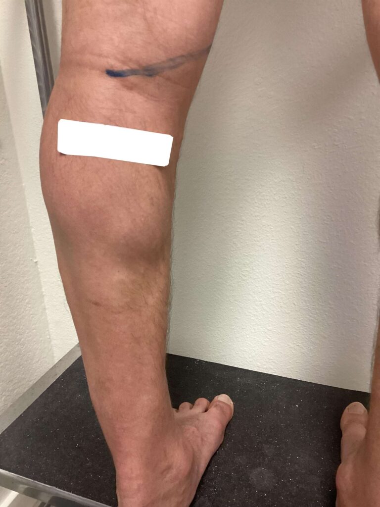 Before Image: Varicose Veins - back