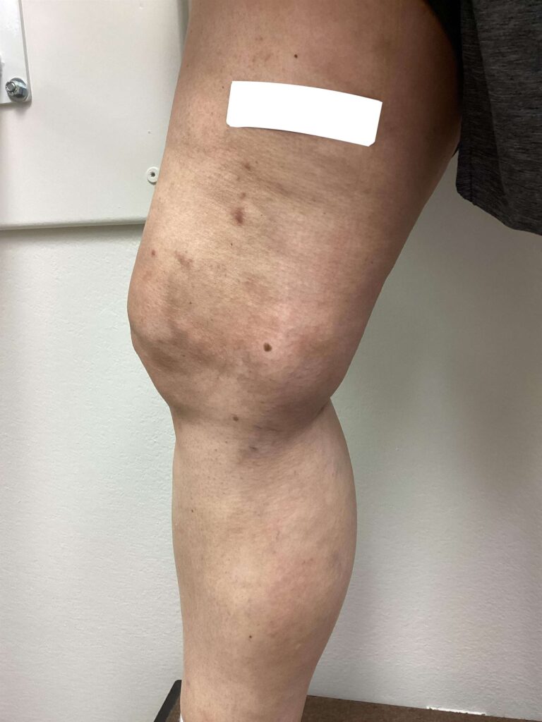 After Image: Varicose Veins - front