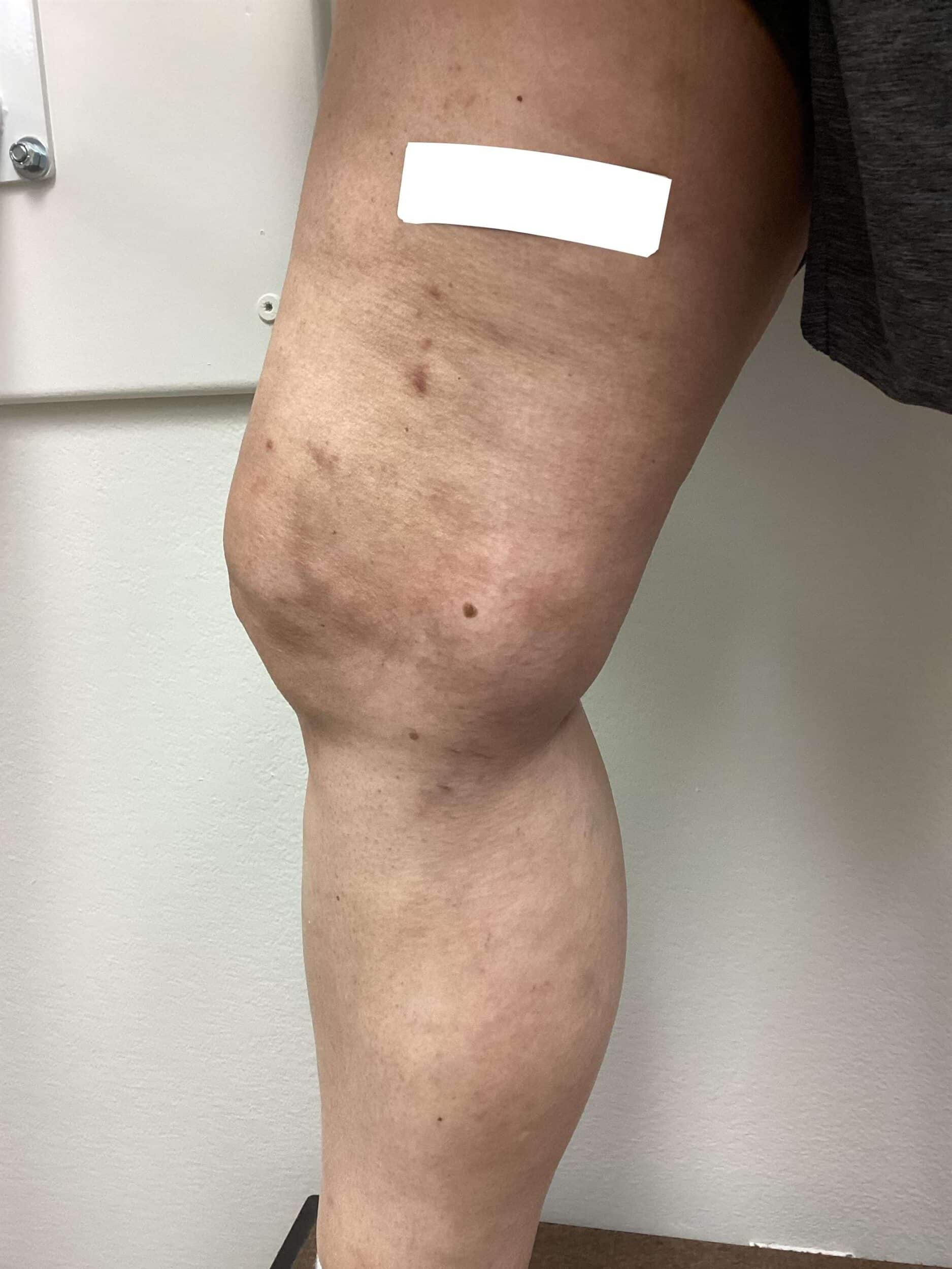 After Image: Varicose Veins - front